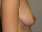 Patient # 63968 Before Photo # 3