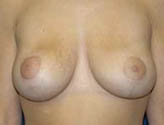 Patient # 32434 After Photo # 2