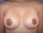 Patient # 33624 After Photo # 2