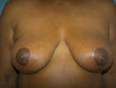 Patient # 54468 After Photo # 2