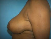 Patient # 54468 After Photo # 4