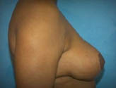 Patient # 54468 After Photo # 6
