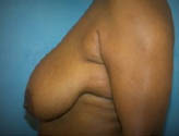 Patient # 54468 Before Photo # 3