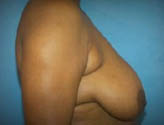 Patient # 54468 Before Photo # 5