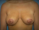 Patient # 97368 After Photo # 2