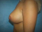 Patient # 97368 After Photo # 4