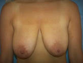 Patient # 97368 Before Photo # 1