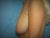 Patient # 97368 Before Photo # 3