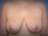 Patient # 14739 After Photo # 2