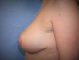 Patient # 14739 After Photo # 4