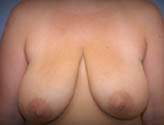 Patient # 14739 Before Photo # 1