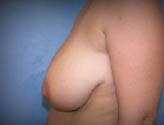Patient # 14739 Before Photo # 3