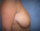 Patient # 14739 Before Photo # 5