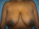 Patient # 92768 Before Photo # 1