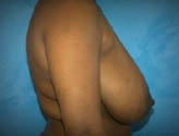 Patient # 92768 Before Photo # 5