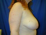 Patient # 34196 Before Photo # 9