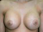 Patient # 90191 After Photo # 2