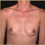 Patient # 24036 Before Photo # 1