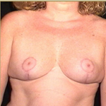 Patient # 13278 After Photo # 2