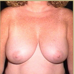 Patient # 13278 Before Photo # 1