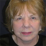 Patient # 84925 After Photo # 2
