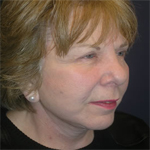 Patient # 84925 After Photo # 4