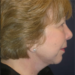 Patient # 84925 After Photo # 6