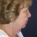 Patient # 84925 Before Photo # 5
