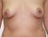 Patient # 71301 Before Photo # 1