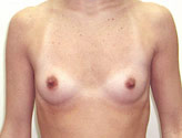 Patient # 55445 Before Photo # 1