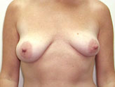 Patient # 18552 Before Photo # 1