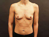 Patient # 80455 Before Photo # 1