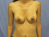 Patient # 73028 After Photo # 2