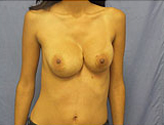 Patient # 73028 Before Photo # 1