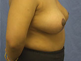 Patient # 21535 After Photo # 4