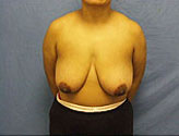 Patient # 21535 Before Photo # 1
