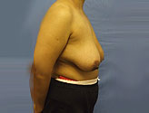 Patient # 21535 Before Photo # 3