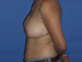 Patient # 90637 After Photo # 4