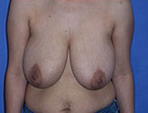 Patient # 90637 Before Photo # 1