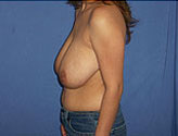 Patient # 90637 Before Photo # 3