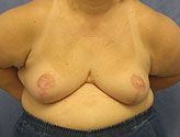 Patient # 18741 After Photo # 2