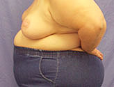 Patient # 18741 After Photo # 4