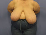 Patient # 18741 Before Photo # 1