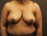 Patient # 68811 After Photo # 2