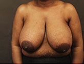 Patient # 68811 Before Photo # 1