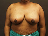 Patient # 87745 After Photo # 2