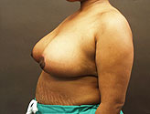 Patient # 87745 After Photo # 4