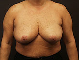 Patient # 98296 After Photo # 2