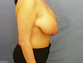 Patient # 72070 Before Photo # 3