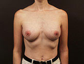 Patient # 45142 After Photo # 2